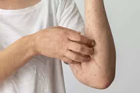 is the problem of itching or skin rash