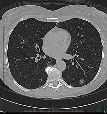 lung cancer groundglass opacity ggo