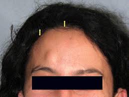 endoscopic excision of forehead lipomas