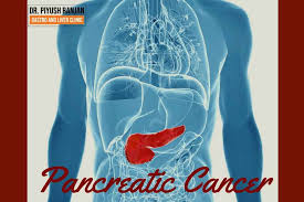 For people in families at high risk of pancreatic cancer, newer tests for detecting pancreatic cancer early may help. Pancreatic Cancer Symptoms And Causes Dr Piyush Ranjan