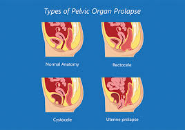 pelvic organ prolapse aaurology