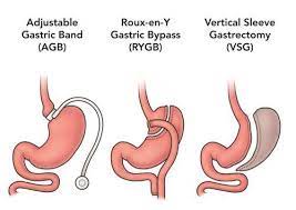 after bariatric surgery