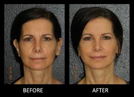 Fillers are a type of minimally invasive aesthetic medicine used to add volume, alter the contours of the face, and fill in wrinkles. Facial Fillers Medical Spa In Montrose Houston Tx