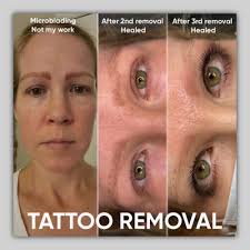 saline tattoo removal in san go cost