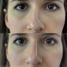 Review the surgeons before and after photographs to ensure expertise. I Had Nose Fillers And This Is What Happened Healthista