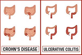 Crohns Disease Vs Ulcerative Colitis Differences In