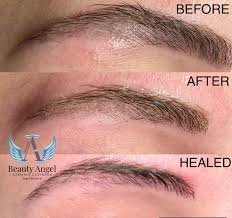 eyebrow laser tattoo removal vancouver