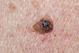 warning signs of skin cancer pictures