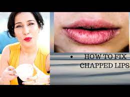 fix chapped lips chapped lips remedy