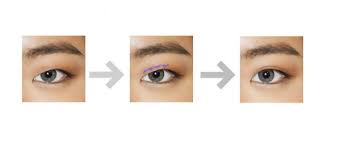 asian double eyelid cosmetic surgery