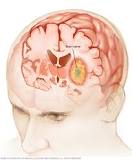 What were your first signs of a brain tumor?