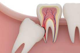 impacted wisdom tooth symptoms