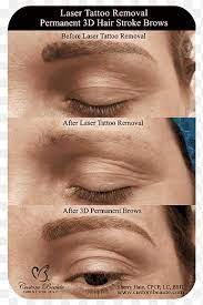 eyebrow tattoo removal permanent makeup