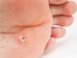 radiofrequency removal of plantar warts