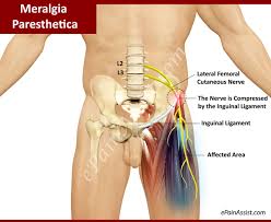 upper leg nerve pain meralgia