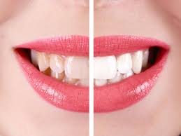the top 5 tooth whitening questions
