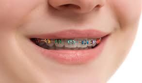 Sometimes, an orthodontist will suggest a patient wears rubber bands with their braces. An Underbite Might Be Improved By Traditional Braces Orthodontic Blog Orthodontic Specialists Of Lake Countyorthodontic Blog Orthodontic Specialists Of Lake County