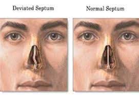 deviated nasal septum by dr radhika