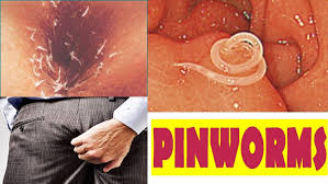 pinworm infection symptoms