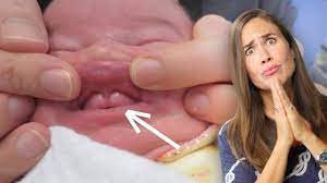 lip tie how to check your baby and