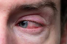 eye inflammation