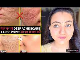 deep acne scars