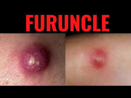 furuncle furuncle boil definition