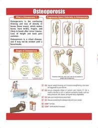 Osteoporosis Pop Up Poster View Specifications Details