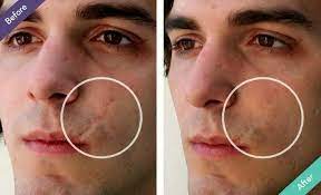 face scars best s for