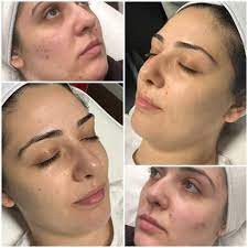 Selfish Beauty Lounge - This is what 4 sessions of Microneedling looks like  😍😍. . . M I C R O N E E D L I N G . Promo pricing