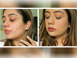 know how to hide acne scars with makeup