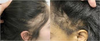 24 causes of hair loss by a dermatologist