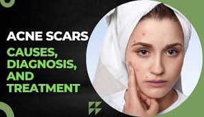 acne scars causes diagnosis and