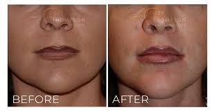 when to consider a lip lift good