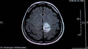 Find the latest information on primary brain tumors and learn how memorial sloan kettering doctors can help or your loved one. Brain Tumors In Children When All That Matters Is Now Science In Depth Reporting On Science And Technology Dw 08 06 2020