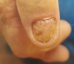 severe nail psoriasis a case report