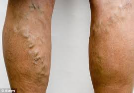 What is ,aching, varicose veins
