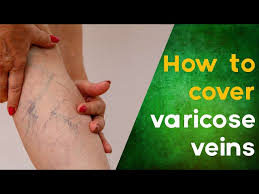 cover varicose veins