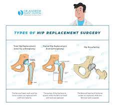 7 signs that a hip replacement surgery