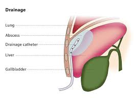 perinephric abscess drainage urologist