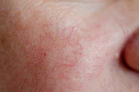 spider veins on your face causes and