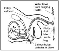 Foley Catheter Wikipedia