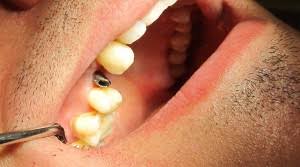 Imagini pentru implant dentar nereusit