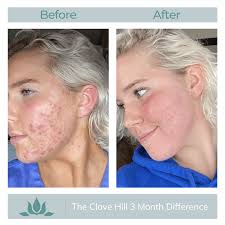 clove hill skin clarity natural acne