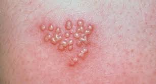 In fact, yeast infection pimples can form here because of sweat and heat. Herpes Simplex Dermatologist In Lincoln Ne Strnot Dermatology