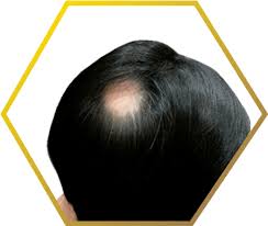 spot baldness alopecia areata