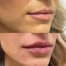 lip injections before and after adam