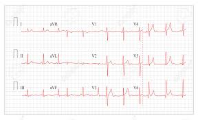 Heart Cardiogram Chart Vector Set Healthy Heart Rhythm Ischemia