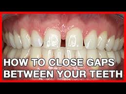 Do you not get them closed for fear of braces?now there is a new technique that can be used to close the spaces without any b. Pin On Things For My Teeth