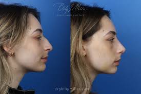 nose taping after rhinoplasty philip